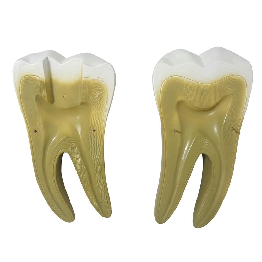 Dente Molar Ampliado Evolução da Cárie em 8 Parte